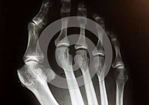 X-Ray image of forefoot with hallux valgus deformity