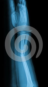 X-ray image of fracture forearm and wooden splint.