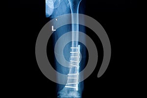 x-ray image of fracture leg ( femur )with implant plate and
