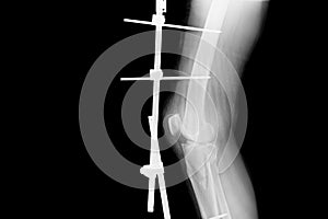 X-ray image of fracture leg with implant external fixation.
