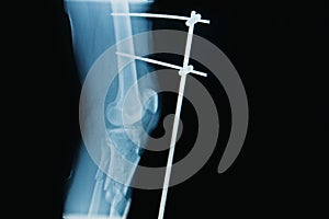 X-ray image of fracture leg ( tibia )