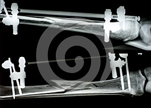 X-ray image of fracture leg ( tibia )with implant external fixation photo