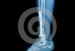 X-ray image of fracture leg (tibia )with implant photo