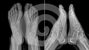 X-ray image of the girl's feet (two views with partially outline
