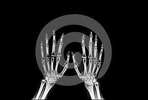 X-ray image of hand in grey tone