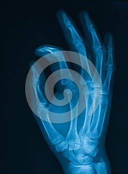 X-ray image of hand.