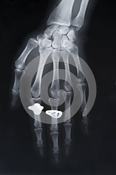 X-ray image of hand with two rings