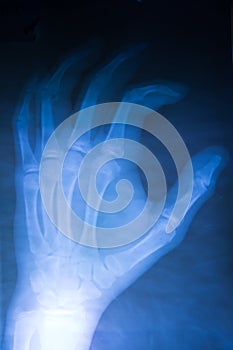 X-Ray image hands