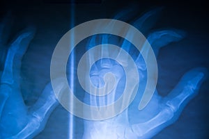 X-Ray image hands