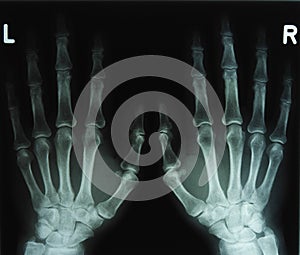 X-ray image of the hands