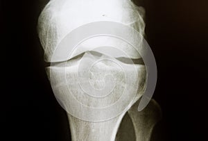 X-ray image of healthy regular knee with normal joint space negative results