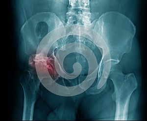 X-ray image hip avascular necrosis