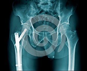 X-ray image hip fracture or intertrochanteric fracture and post internal fixation