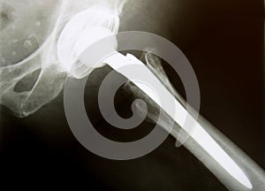X-Ray image of hip with implanted artificial joint replacement Endoprosthesis in case of coxarthrosis joint degeneration