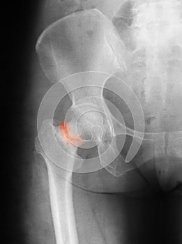 X-ray image of hip joint, antero-posterior view,