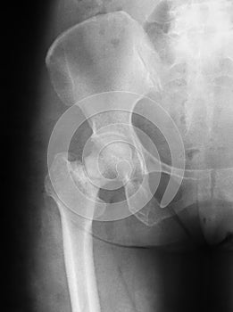 X-ray image of hip joint, AP view, preoperative.