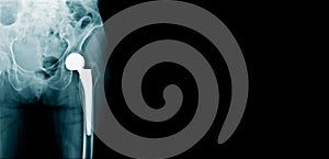 X-ray image of hip replacement on black background