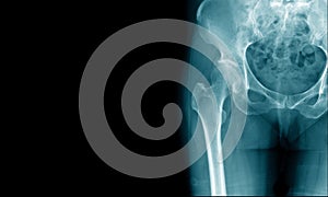 X-ray image of hip and show degenerative change