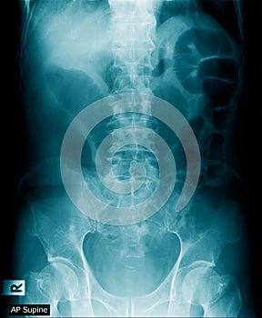 X-ray image of human abdomen, picture of human spine