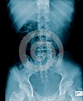 X-ray image of human abdomen, picture of human spine