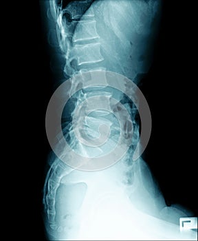 X-ray image of human abdomen, picture of human spine