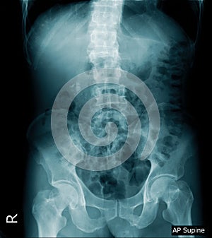 X-ray image of human abdomen, picture of human spine and pelvic bone show degenerative change of spine