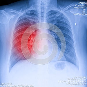 X-Ray Image Of Human Chest for a medical diagnosis, shows pain area with red. Thorax x-ray for lungs examination, PA up right