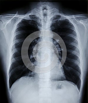 X-ray image of human chest and pulmonary for a medical diagnosis