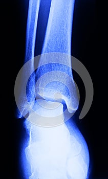 X-ray image of human foot joint