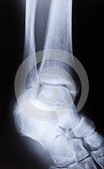 X-ray image of human foot joint , side view