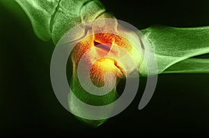 X-ray image of human foot joint