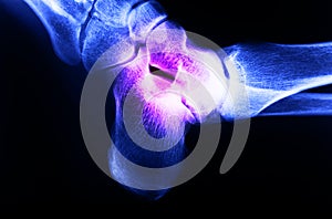 X-ray image of human foot joint