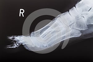 X-ray image of human foot