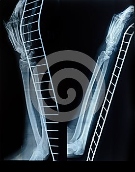 X-Ray image of human hand and arm after a fracture on the metal