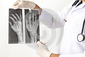 X-Ray image of human hands,Doctor examining a lung radiography, Doctor looking chest x-ray film,Anatomy.