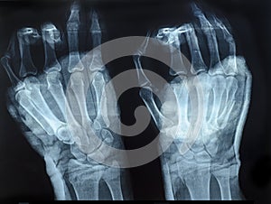 X-Ray image of human hands