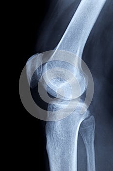 X-ray image of a human knee laterally