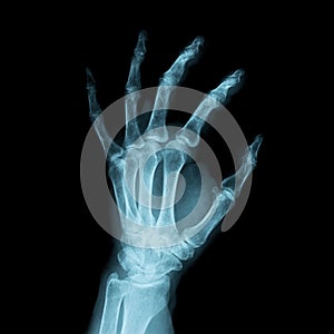 X-ray Image of a human left hand