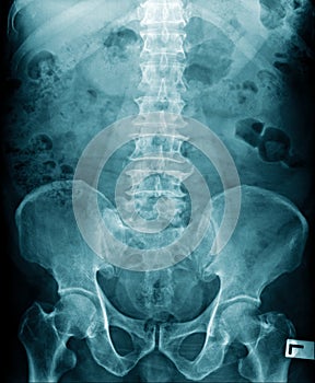 X-ray image of human spine and show lumbar spondylosi