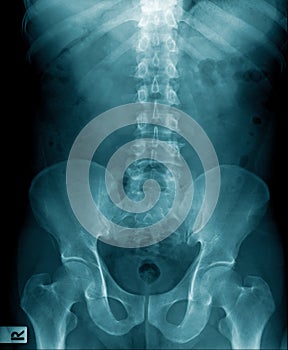 X-ray image of human spine and show lumbar spondylosis