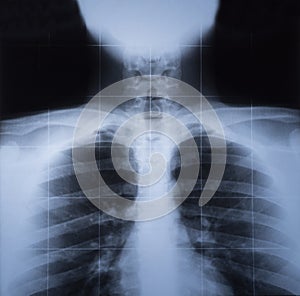 X ray image of human thorax