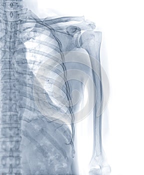 X-ray image of humerus bone.