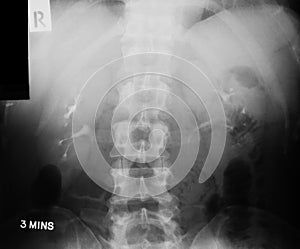 X-ray image of IVP(Intravenous Pyelogram)