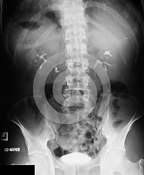 X-ray image of IVP, prone position.