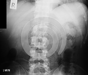 X-ray image of IVP, supine view.