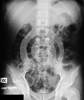 X-ray image of IVP, supine view.