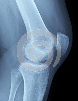 X-Ray image of a knee photo