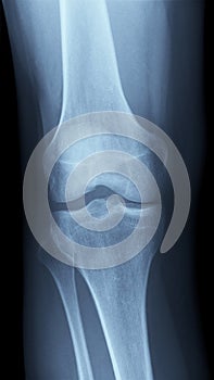 X-Ray image of a knee