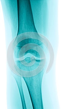 X-Ray image of a knee photo