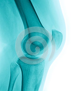 X-Ray image of a knee